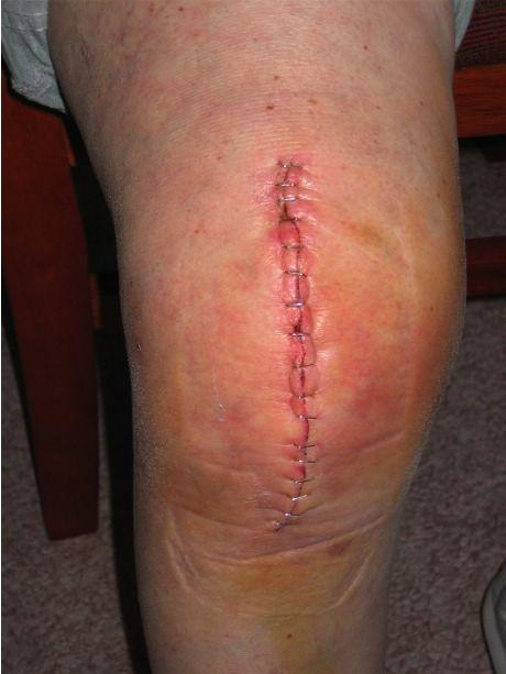 knee_replacement2.jpg