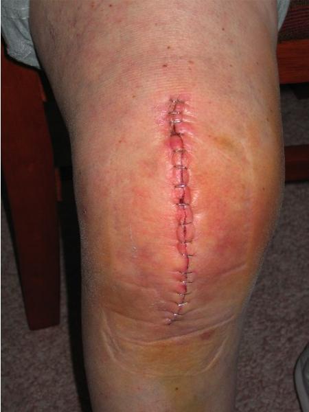 knee_replacement2.jpg